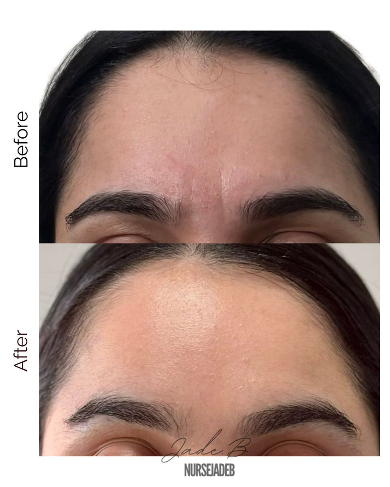 Forehead Treatment