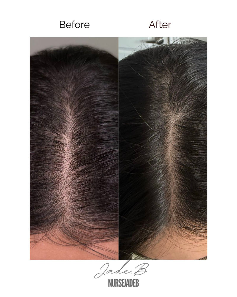 Hair Loss Treatment
