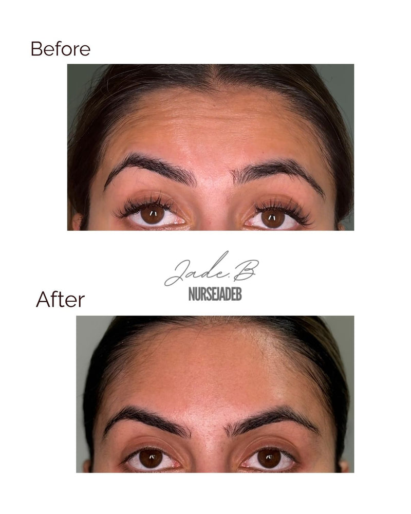 Forehead Treatment (preventative)