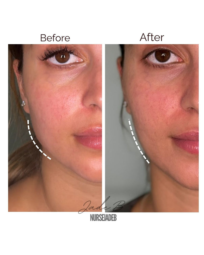 Masseter/TMJ Treatment