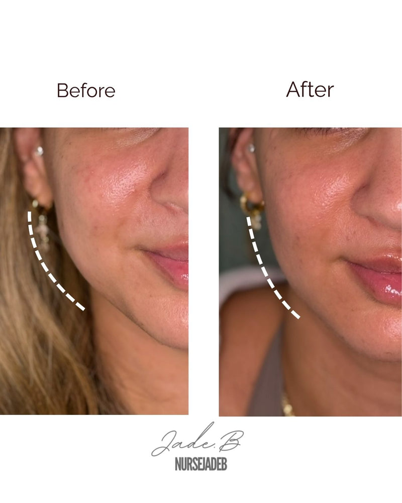 Masseter/TMJ/Facial Slimming Treatment