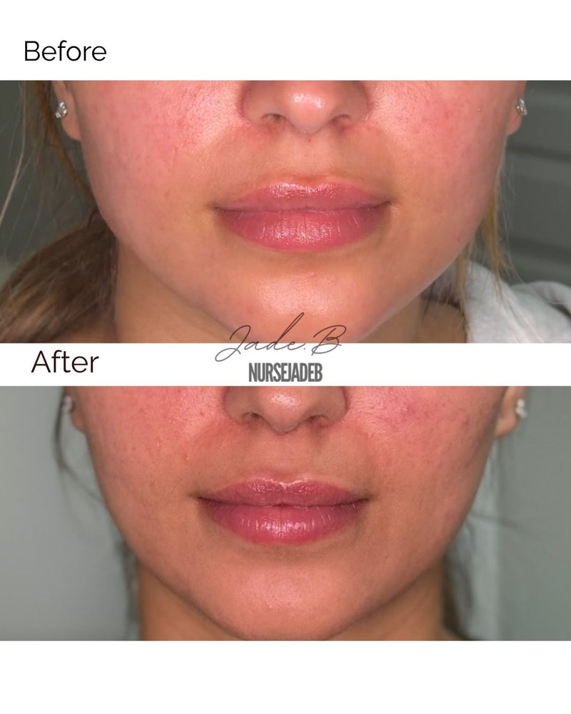 Masseter/Facial Slimming Treatment