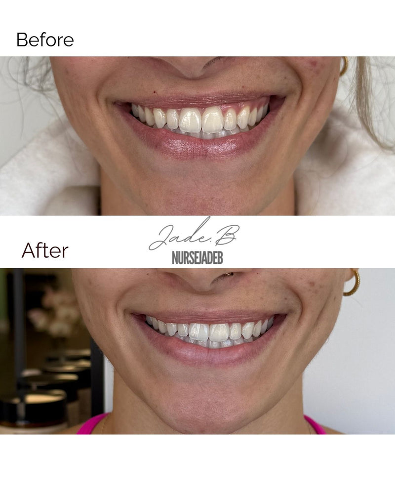 Gummy Smile Treatment