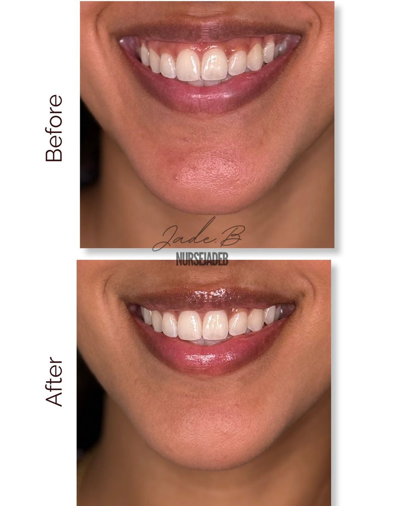Gummy Smile Treatment - Botox